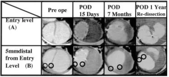 Fig. 3 Relation between stent distal end and entry POD: Post Operative Date