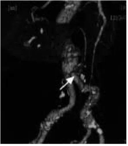 Table Reported cases of operation for abdominal aortic aneurysm with horseshoe kidney in Japan  No