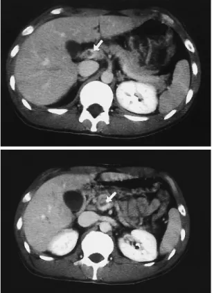 Fig. 1 The computed tomography (CT) demonstrated the superi- superi-or mesenteric vein-psuperi-ortal venous thrombus (arrow)