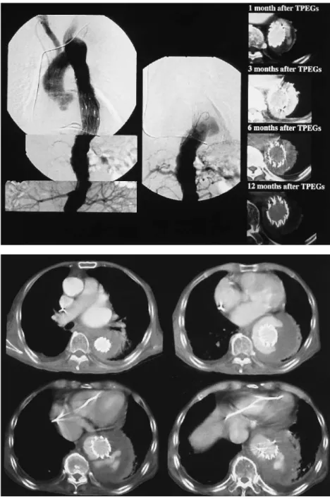 Fig. 2 DSA after one month post TPEGs and postoperative CECT