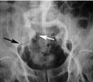 Fig. 2 Intraoperative angiography for an identification of the orifice of the right internal iliac artery
