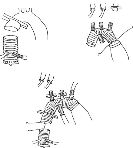 Fig. 3 Schema showed the operative procedure