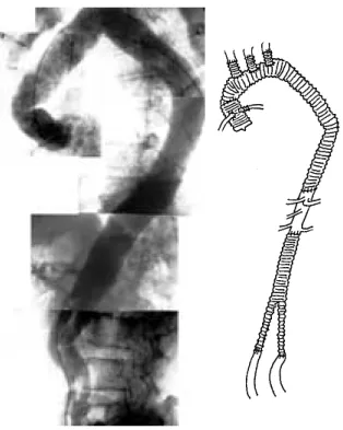 Fig. 5 Postoperative aortography and schema