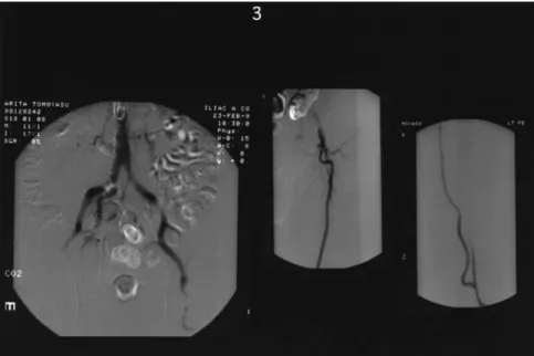 Fig. 3 Pre and post operative CO 2 arteriogram of case 3 (renal insufficiency)