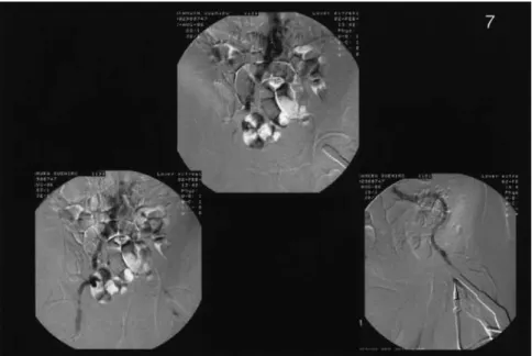 Fig. 7 CO 2 arteriogram of case 7 (chronic renal failure (HD))