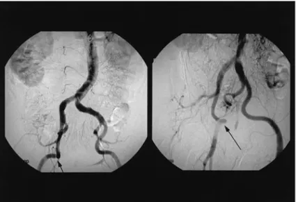 Fig. 2 Intraoperative DSA, post stenting