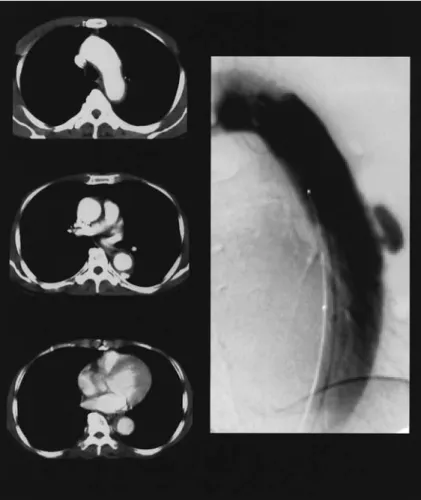 Fig. 2 Chest CT and Aortography on day 51