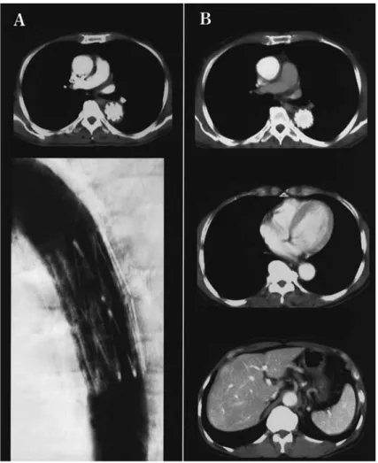 Fig. 3 Post operative chest CT and Aortography