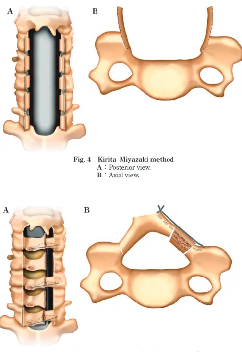 Fig. 5 En bloc laminoplasty（Ito Tsuji method） A：Posterior view.