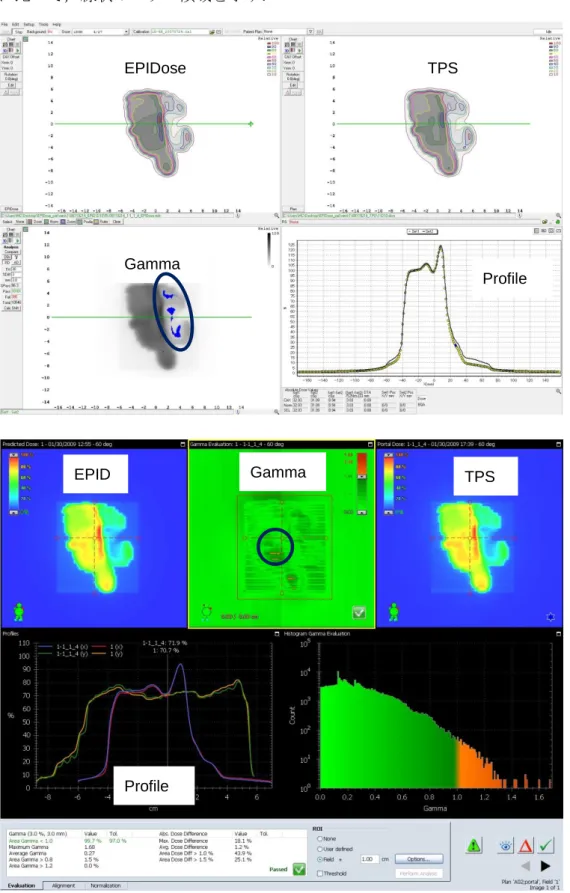 図 4-13 に頸部 7 ビームの 1 ビーム目の EPIDose と EPID の違いを示す．EPID は EPIDose に比べて，線状のエラー領域を示す．  図 4-13  上段 EPIDose，下段 EPID．主なエラー領域を黒丸で示す． EPIDose TPS Gamma  Profile EPID Gamma TPS Profile 
