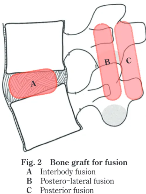 Fig. 2 Bone graft for fusionBA