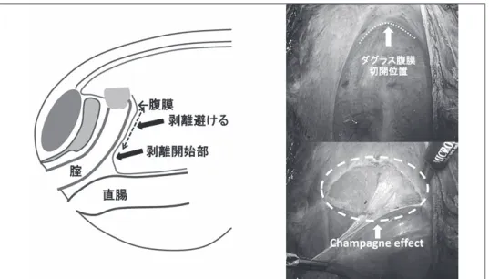 Fig. 10 　ダグラス腹膜切開位置と後腟壁直腸間の Champagne effect．