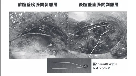 Fig. 16 　経腟的USによる剥離層・範囲の確認：ステンレスワッシャーを剥離面に置いたところ．