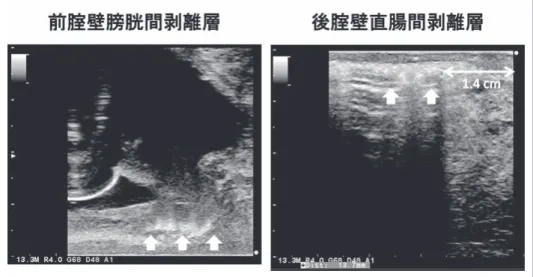 Fig.  17 　経腟的USによる剥離層・範囲の確認のエコー写真：左の矢印が膀胱頸部剥離層のス テンレスワッシャー陰影で，右が直腸腟壁間剥離層のステンレスワッシャー陰影で写真右端が 腟入口部．