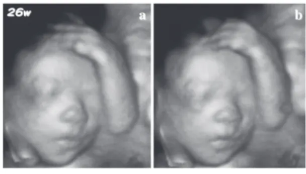 図 9　指しゃぶりしている胎児 (fetal sucking) (a-c) (Hata  T,  et  al.  Donald  Scool  J  Ultrasound  Obstet  Gynecol 2010;4:233-248 より引用 6) )