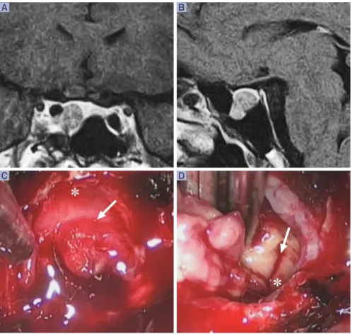 図 1 症例 1： 64 歳男性 先端巨大症症例（GH-producing pituitary adenoma） 術前造影 MRI（A： T1WI 冠状断，B： T1WI 矢状断）．C, D： 神経内視鏡下術中写真（矢印： 腫瘍正常 下垂体境界部〔仮性被膜〕，＊： 正常下垂体）．