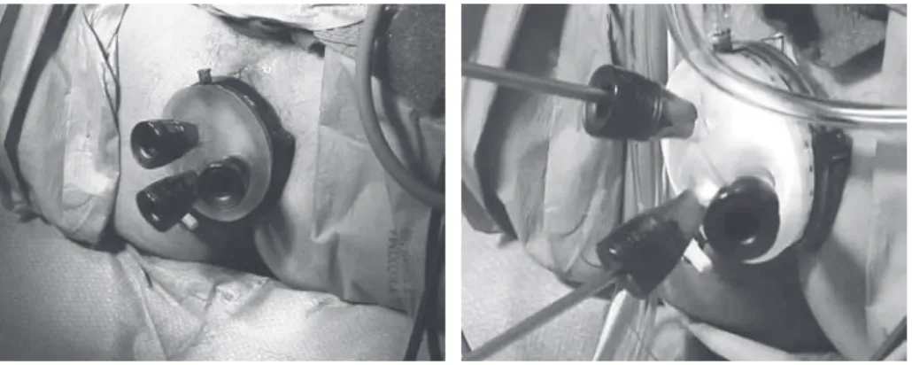 Fig. 2　Preparation of GelPOINT ®  Path. a-b : Operation is performed with the usual laparoscopic instruments