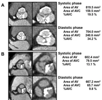 Figure 1 Representative cases of multidetector computed tomo- tomo-graphy in patients with severe AVC (A) and moderate AVC (B) (A) Echocardiographic findings showed an aortic valve area of 0.68 cm 2 and mean aortic gradient of 45 mmHg