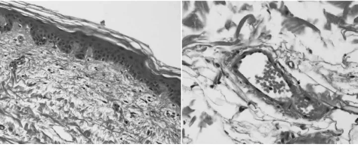 Fig. 2. 　 Skin biopsy findings