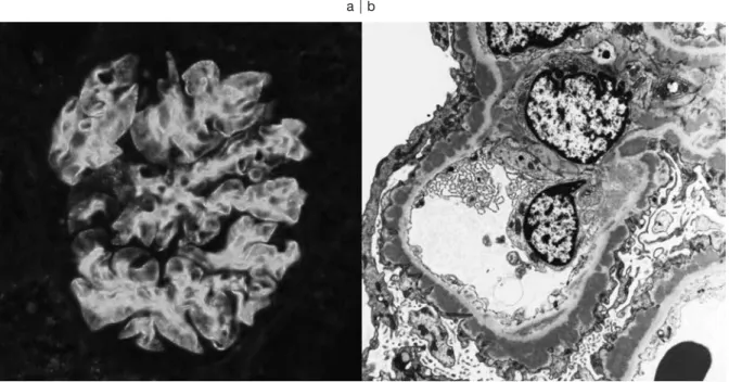 Fig. 2. Histopathological features of a renal biopsy specimen a: Immunofluorescence study; diffuse granular capillary wall deposits of C3