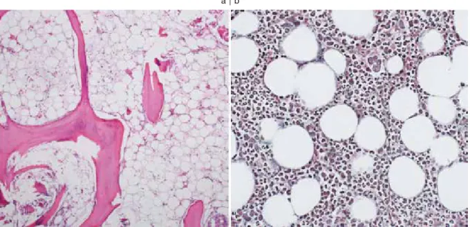 Fig. 3.　Histopathological examination of the bone marrow  （a：HE stain, ×100，b：silver stain, ×400）