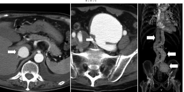 Fig. 2.   Early phase-enhanced abdominal computed tomography （ CT ） findings （ a, b ） and three-dimensional reconstruction of CT （ c ） a, b ： Arrows show the inferior vena cava and fistulous communication of the left common iliac artery with vein, respecti