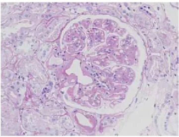 図 4   PGNMID, IgG3 κ型（ PAS 染色）