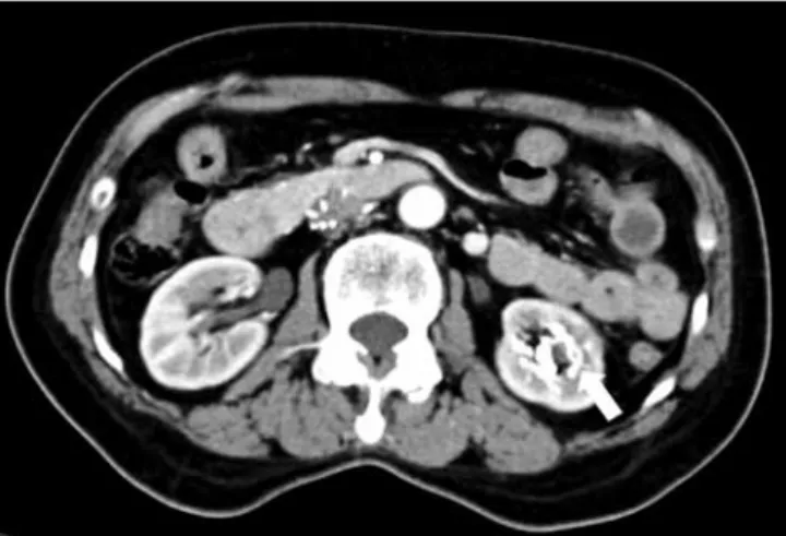 Fig. 2.     Enhanced abdominal computed tomography after treating  coil embolization （ arrow ） for the left renal arteriovenous  fistula  （ Case 1 ）