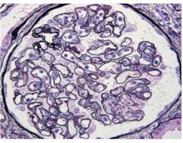 図  3 Transplant glomerulopathy：cg