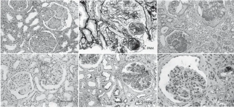 Fig.  1. Renal biopsy