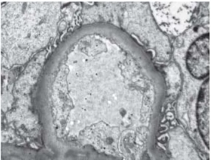 Fig.  2. Electron microscopic findings of the renal biopsy The foot processes are focally effaced