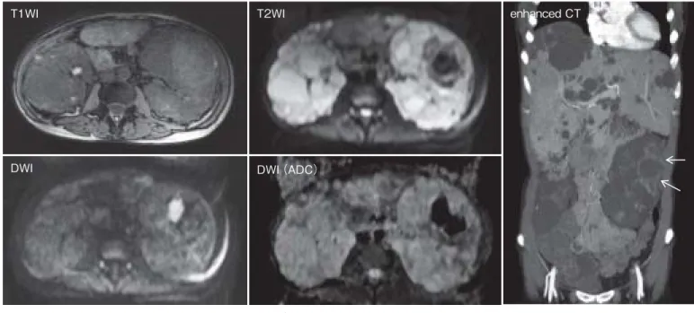 図  2   * 胞感染（肝  * 胞）の FDG-PET／CT 像 （文献 11 より引用）