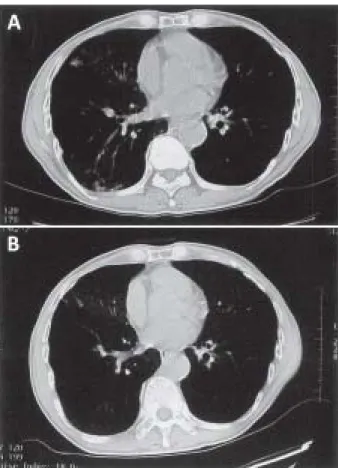 Fig.  2. Light microscopic findings of renal biopsy showing crescent glomerulonephritis