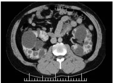 図  8 MRI T2 強調画像 両側腎臓には多数の高信号で均一な大小の  * 胞が認められ る。 図  7 ADPKD の造影 CT 画像 比較的初期の ADPKD であり，まだ腎臓の腫大は明らかではない。大小多数の低吸収域（黒い袋のように見えるもの）が *胞である。図  6 ADPKD の超音波画像大小多数のエコー輝度の低い（黒い）袋のように見えるものが *胞である。矢印で示した内部エコー輝度がやや高く，不均一な *胞は感染あるいは出血が疑われる。   通常行われていないが，進行度や予後判定の一つ の指