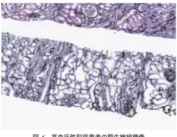 図  6 高血圧性脳症患者の腎生検組織像