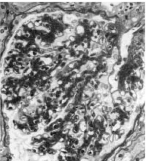 Fig.  7. Light microscopic findings （Periodic acid  Schiff stain） in case 3 （×400）
