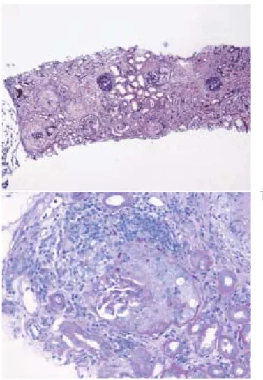 Fig.  1. Histopathology of the renal biopsy specimens  a ：A representative light micrograph shows that almost all 