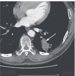 Fig. 2.　A 64 - year - old man with lung adenocarcinoma,  mixed acinar and papillary type