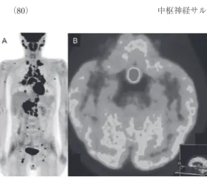 Figure 3.　PET - CT　A : 両側耳下腺周囲から頸部・