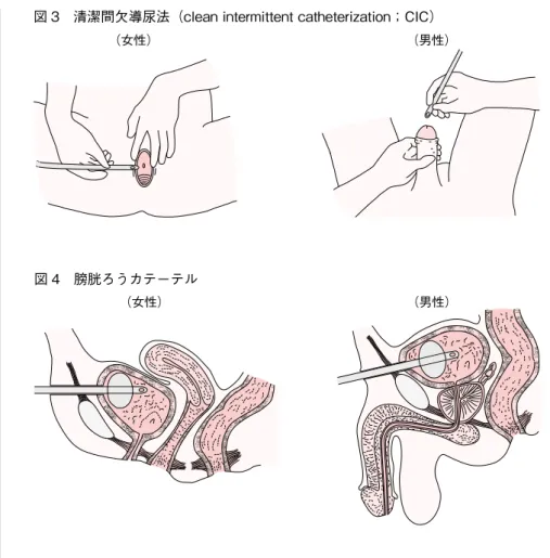 図 3　清潔間欠導尿法（clean intermittent catheterization；CIC）