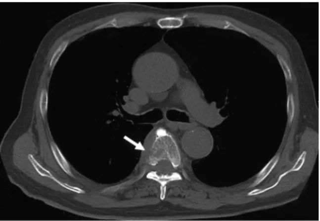 Fig. 1. CT showed an osteolytic change in the 6th thoracic vertebra.