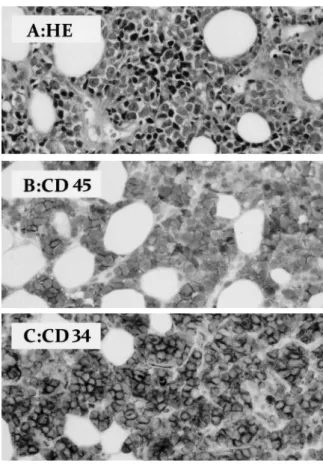 Fig. 3. Pathological appearance of the prostate biopsy (HEstain × 200).