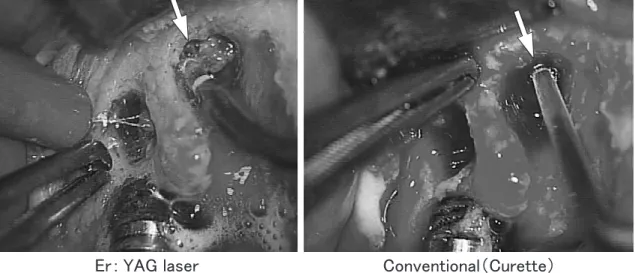 図 8　 術前（中央写真）にあるレントゲン透過像が本法の応用により 3 ヶ月後には左写真のように改善されさら に CT による断層写真においても頬側の骨再生も観察された。