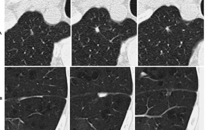 Figure 13. Benign nodules with soft tissue density less than 1 cm in diameter. A and B