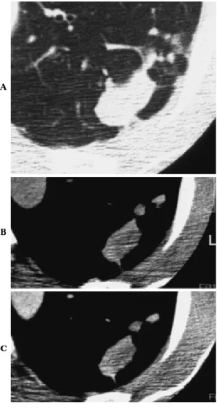 Table 1.  Significance of HRCT findings for malignant nodules in a study including 90 malignant  and 58 benign nodules ≦ 3 cm