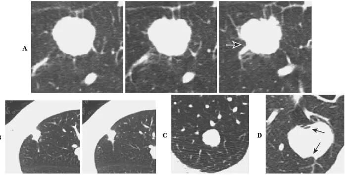 Figure 4. Nodules with soft-tissue attenuation and well-defined borders. A. Squamous cell carcinoma