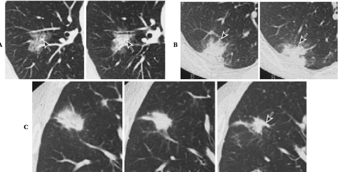 Figure 8. Solitary pulmonary nodules with ground-glass attenuation or fine spiculation at the periphery