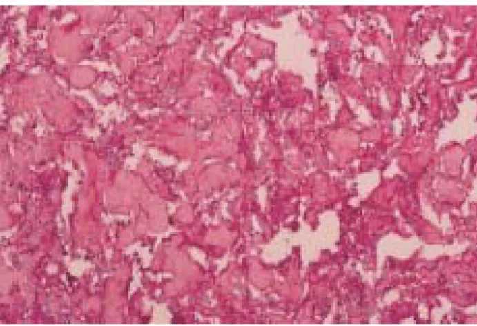 Fig. 6 Histochemical staining revealed the presence of periodic acid Schiff-positive diastase-sensitive granules consistant with glycogen (PAS, × 200).