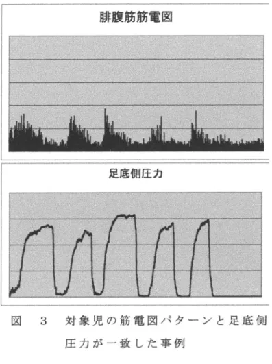 図 3 対象児の筋電図パターンと足底側     圧力が一致した事例