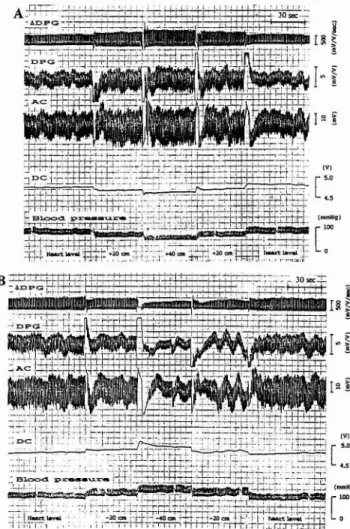 Fig.  1  Responses  of  A D P G   (differential  digital  photo-  plethysmogram),  D P G   (digital  photoplethysmo-  gram),  AC  (AC  component  of  DPG),  D C   (DC  component  of  DPG)  and  arteriolar  blood  pres-  sure  for  20  and  40  cm  upward  